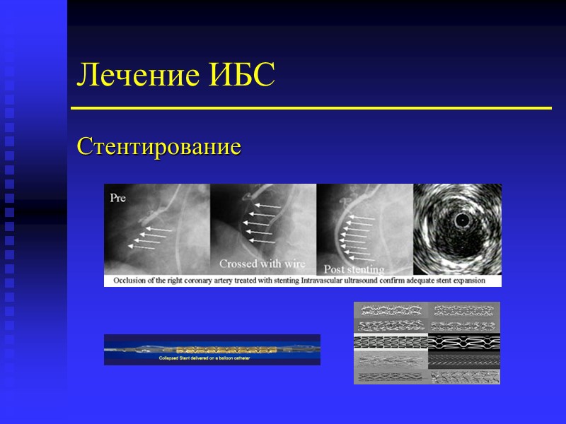 Лечение ИБС Стентирование